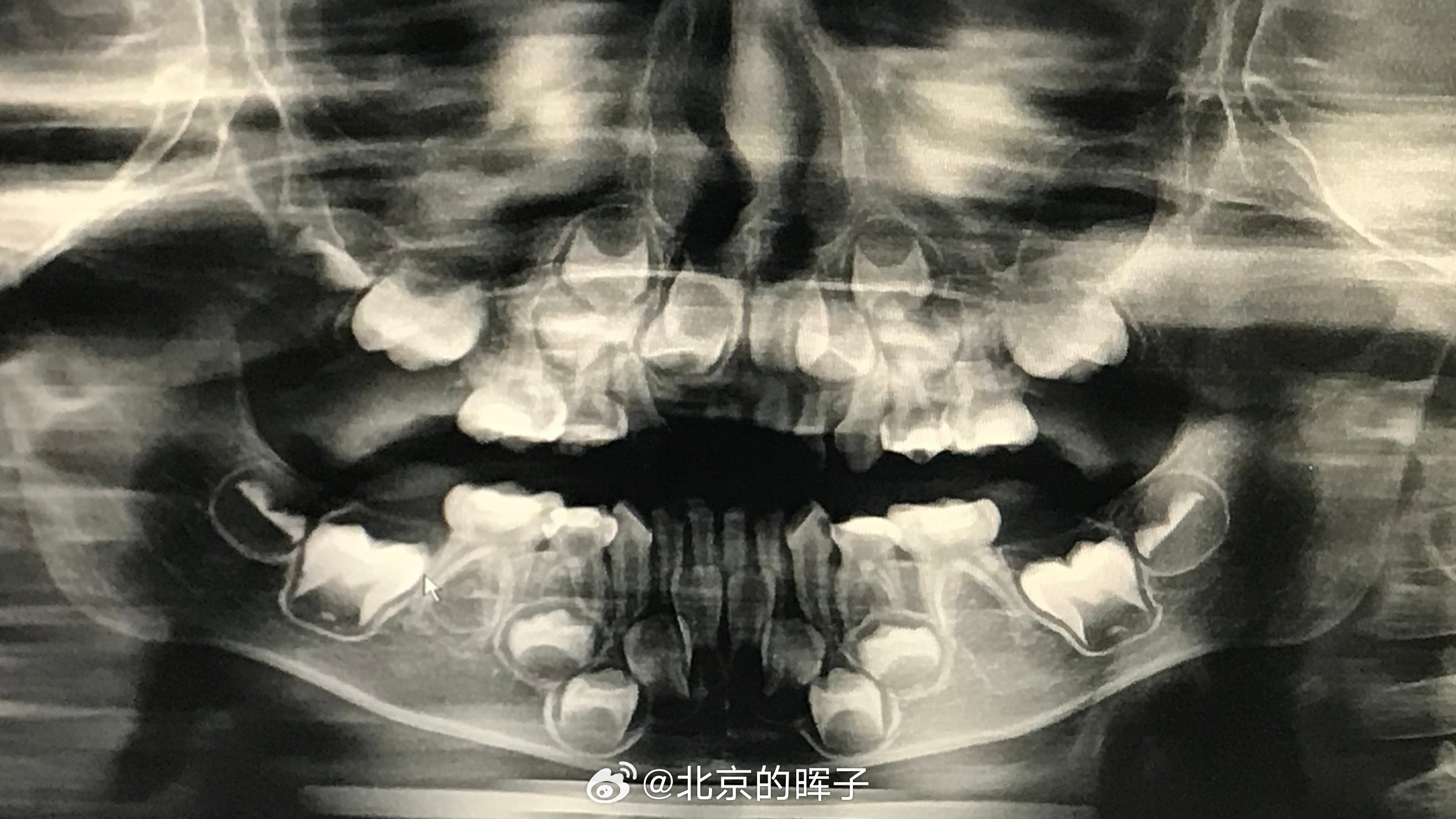 6岁女童因吃得太精细长双排牙