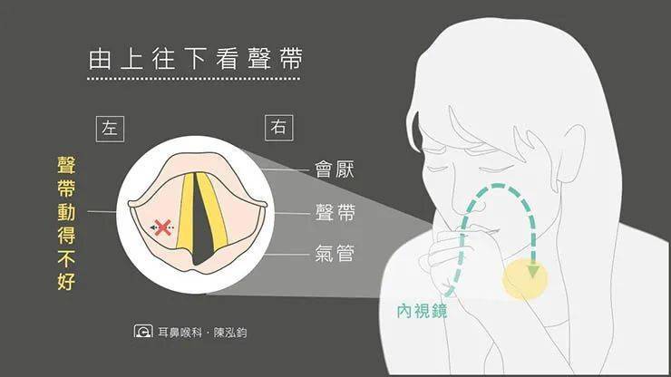 痉挛性发声障碍治疗的研究探讨