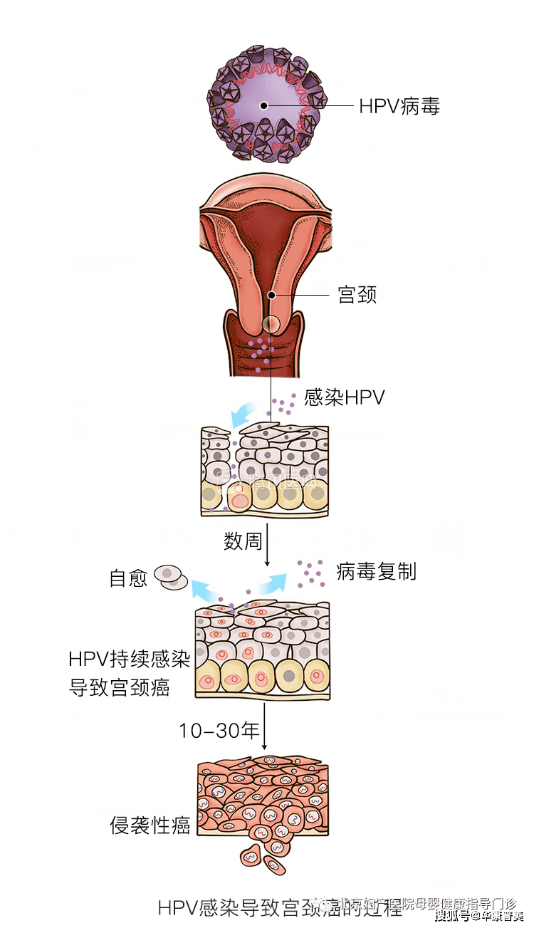 从HPV感染到宫颈癌，5步之遥