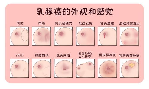 36岁女子查出乳腺癌，早期发现至关重要