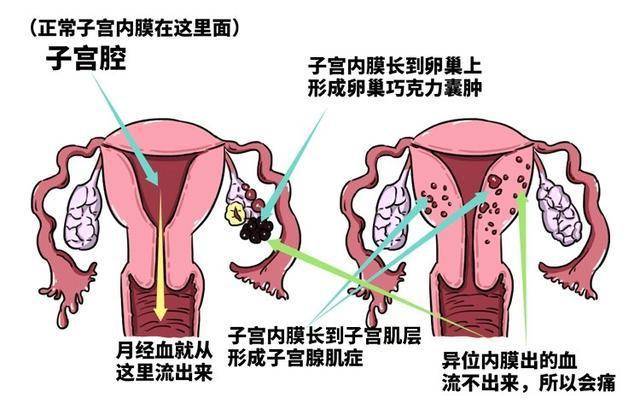 19岁女生每月3周痛经想切子宫，涉政问题的探讨